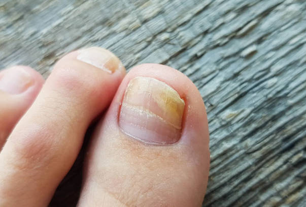 Fungal Nail Infections: Prevention and Long-Term Care