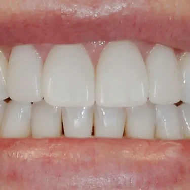 How Do Veneers Work?