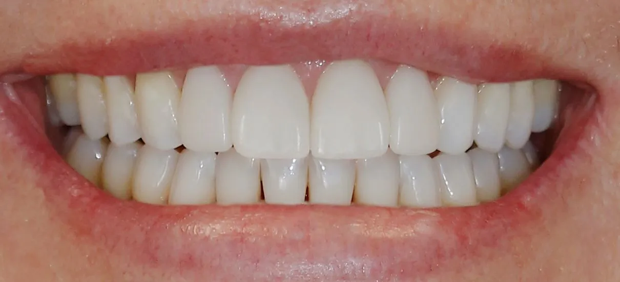 How Do Veneers Work?