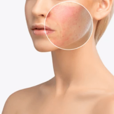 Morpheus8 for Scarring and Stretch Marks