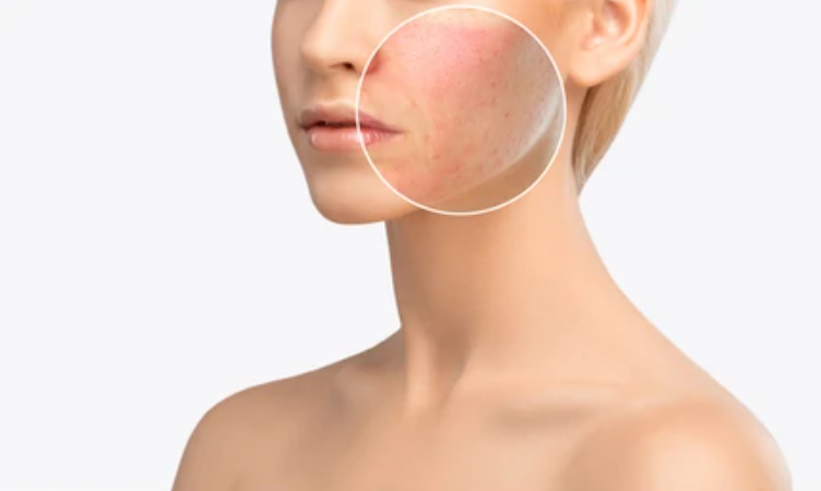 Morpheus8 for Scarring and Stretch Marks