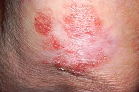 Spotting the Signs of Skin Cancer Early