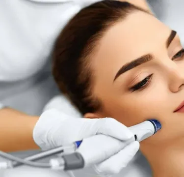 Types of Laser Treatments for Acne and Scarring