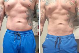 What Areas Can Be Treated with Cool Sculpting for Visible Results?