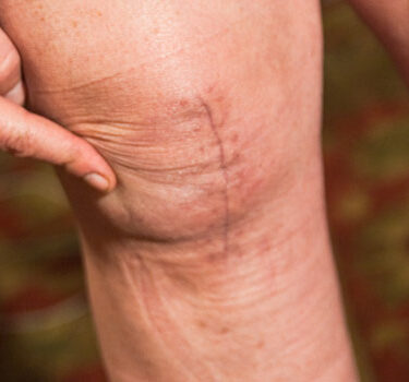 What Causes Arthritis?