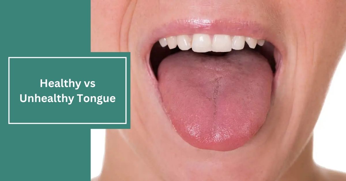 Healthy vs Unhealthy Tongue