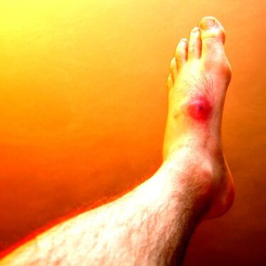 Recovering from an Ankle Injury: What to Expect