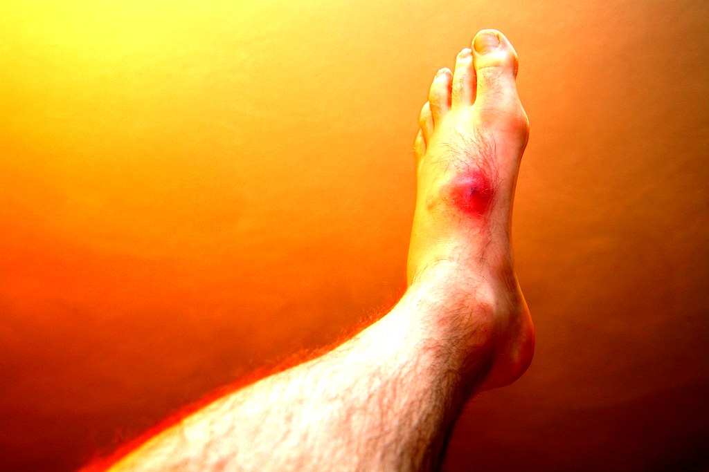 Recovering from an Ankle Injury: What to Expect