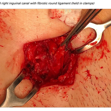 The Role of Surgery in Treating Complex Hernias