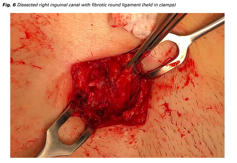 The Role of Surgery in Treating Complex Hernias
