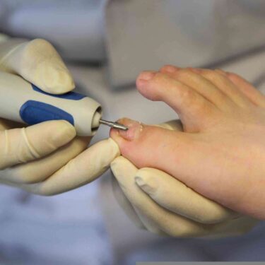 The Role of a Podiatrist in Treating Ingrown Toenails