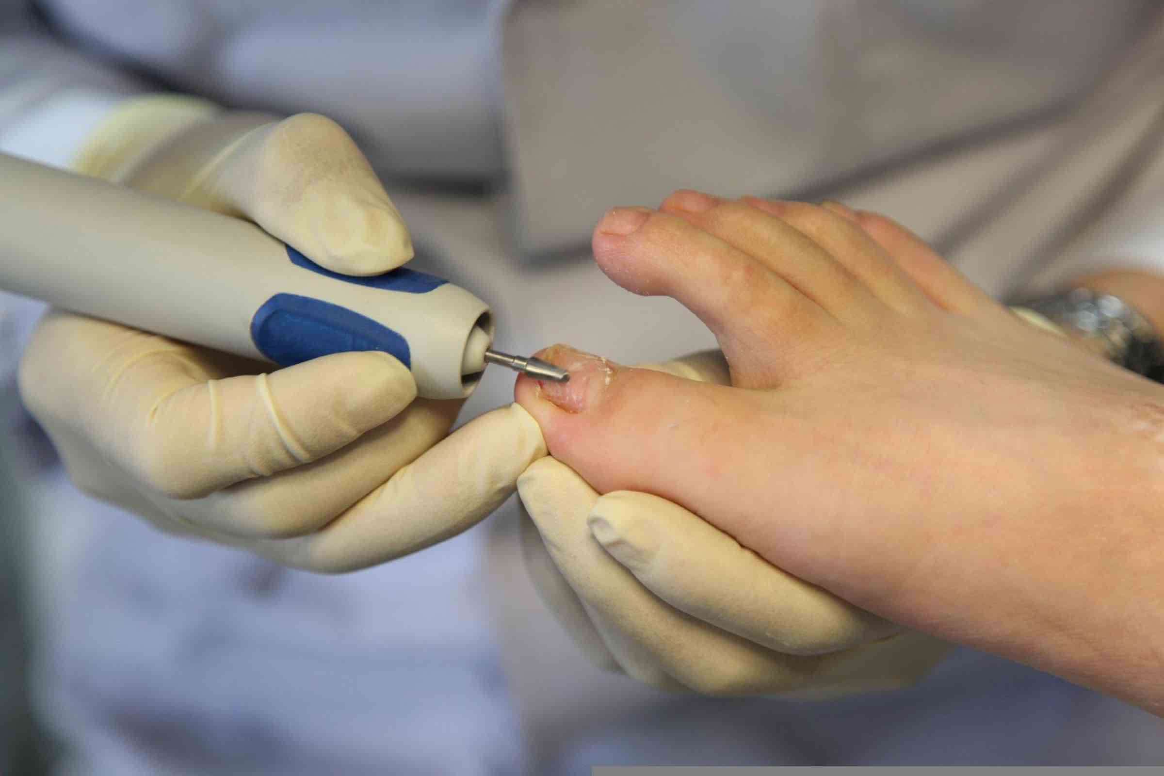 The Role of a Podiatrist in Treating Ingrown Toenails