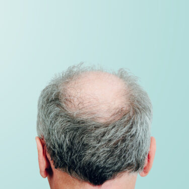 What to Know About Professional Hair Restoration