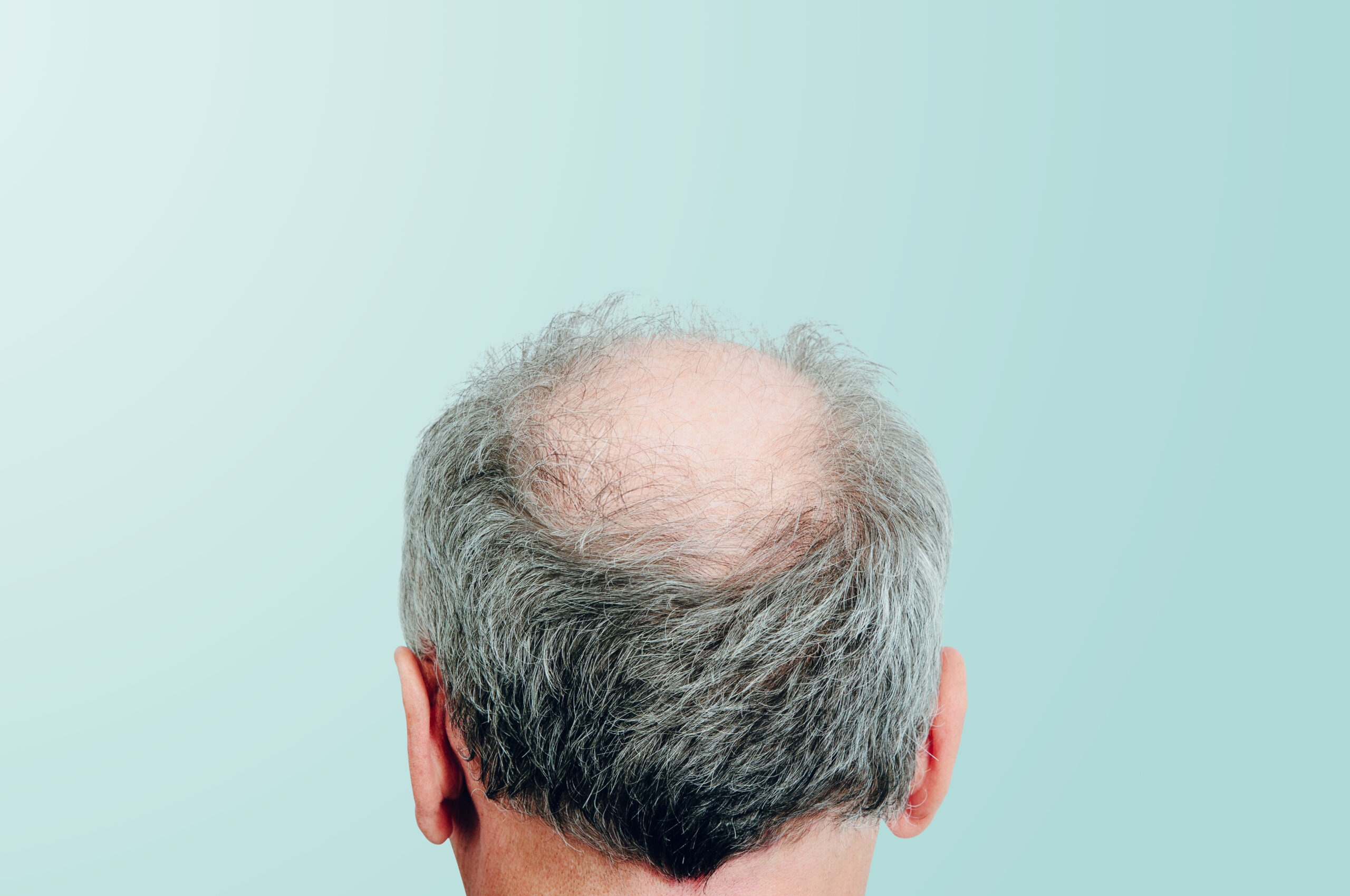 What to Know About Professional Hair Restoration
