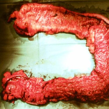 Treatments for Ulcerative Colitis